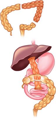 Case Report: Kasai Operation in Biliary Atresia After Extensive Bowel Resection